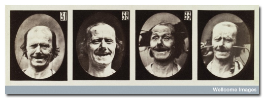 Guillaume-Benjamin-Amand Duchenne cataloged thousands of electroshock therapy sessions spanning 20 years.