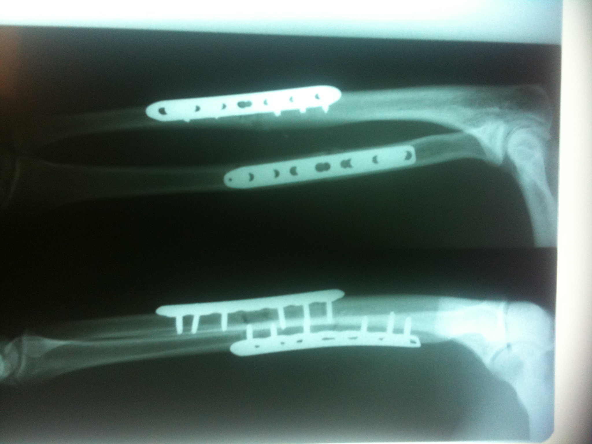 My boyfriend was struck, while walking,  by a motorcycle rider on a stolen bike going 80-100mph..broke both bones in forearm  needed metal plates with screws