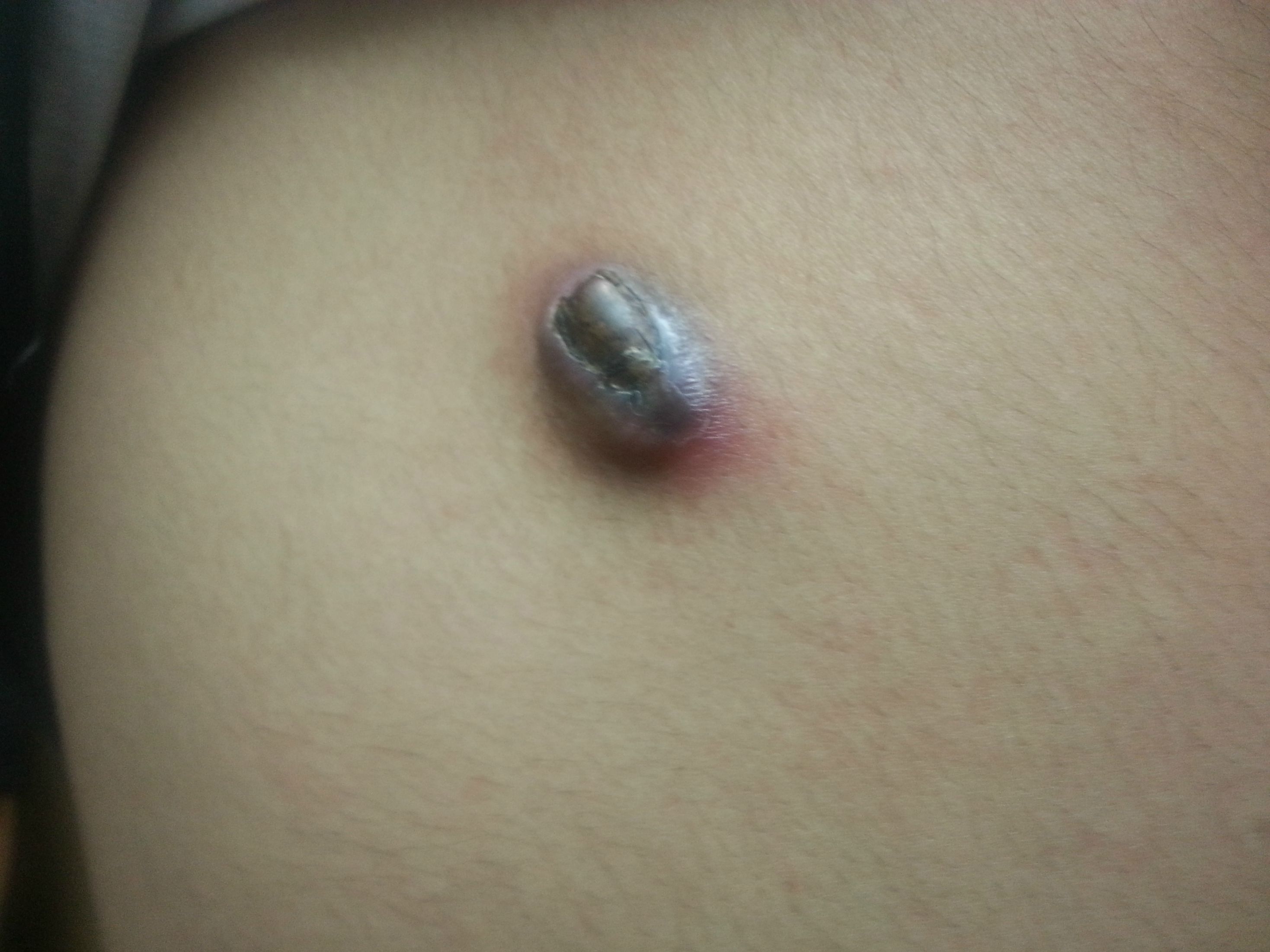 2 years of untreated bullet wound later