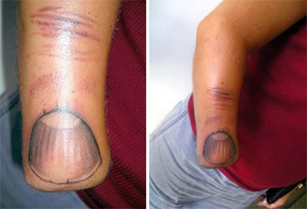 16 People Who Lost Limbs, But Not Their Sense of Humor