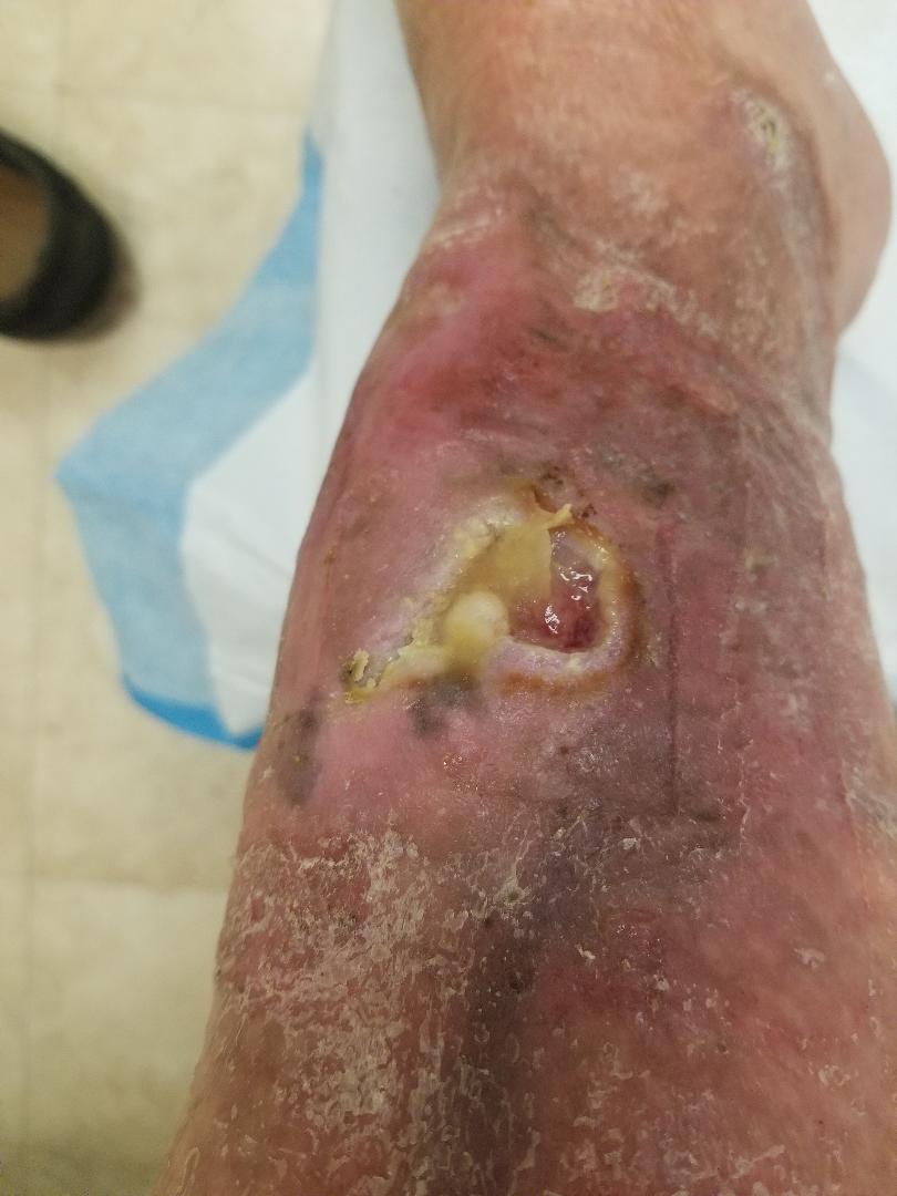 Progress of a month and a half of closing a wound