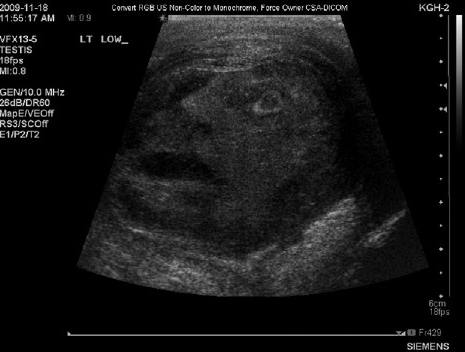 A 45 yr old man's testicular  tumor scan led to the discovery of a creepy face. I wonder if it has a personality? Get it out! Get it out!