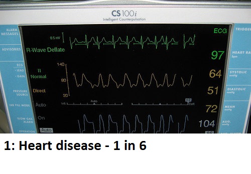 heart attack on monitor - Cs 100i Intelligent Counterpolation Alan Massages Ecg Trigge o mW Advisores R Wave Deflate Heart Ra 140 Lead 50 Systolic Normal Diastolic Was The Mode Auto Operties Alito 1 Heart disease 1 in 6