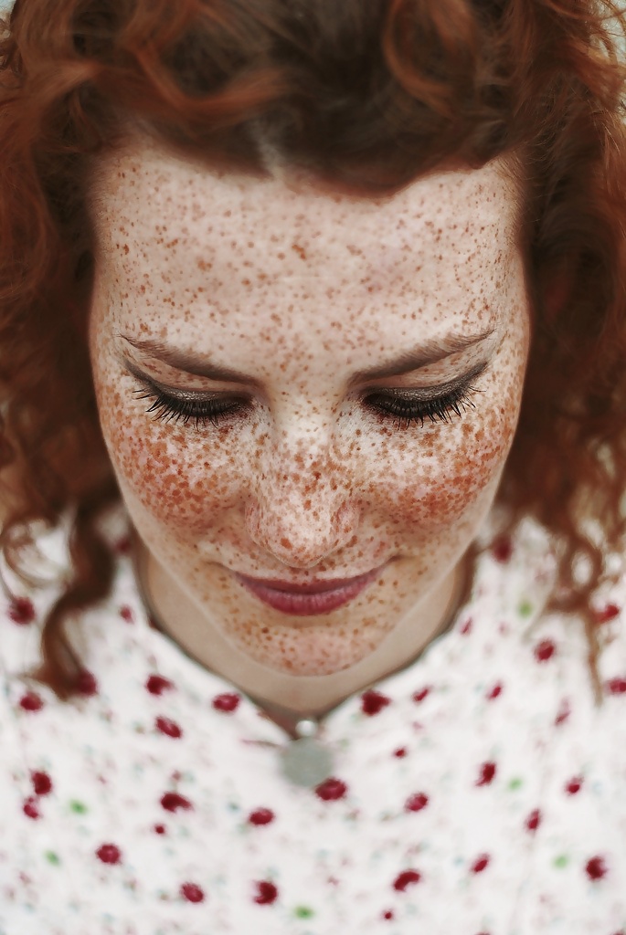 Freckles