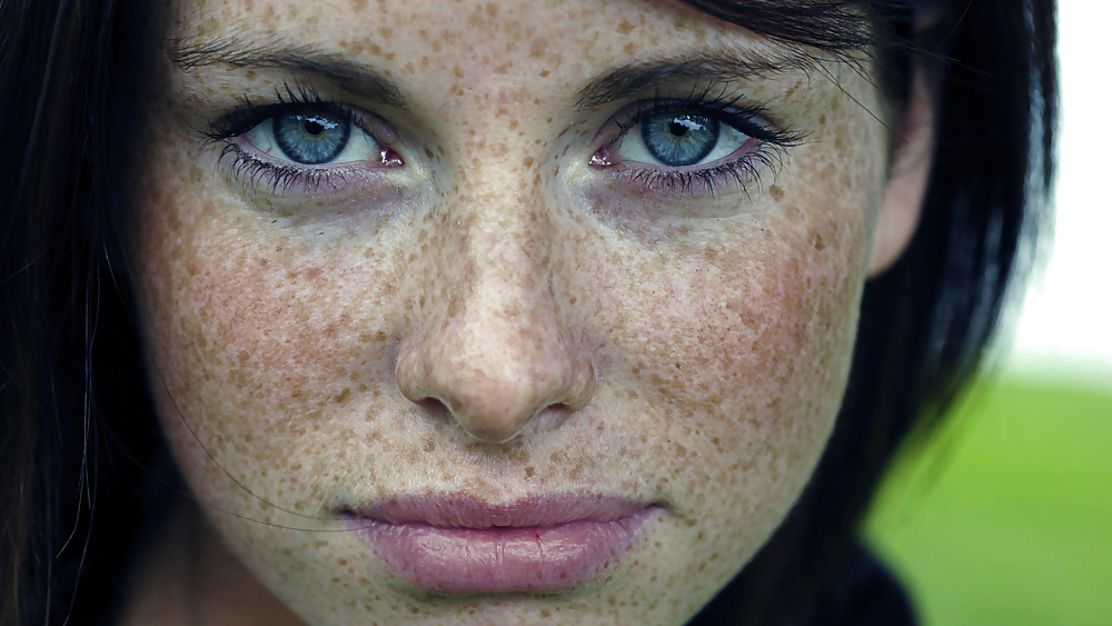 Freckles