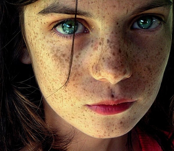 Freckles