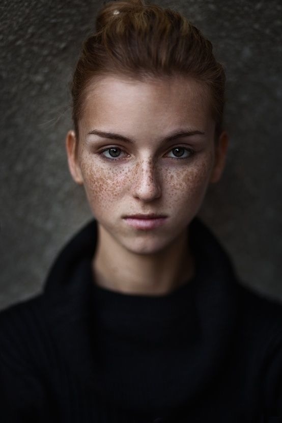 Freckles