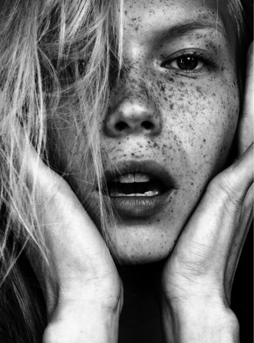 Freckles