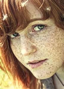 Freckles