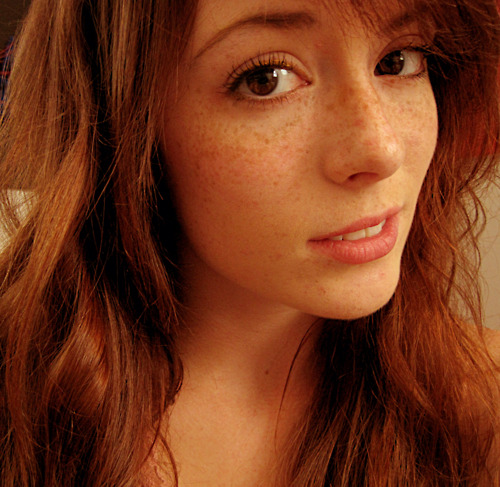 Freckles