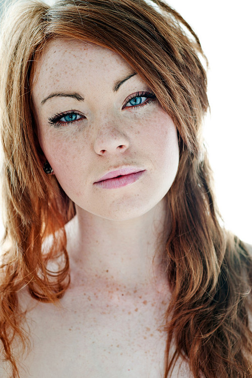 Freckles