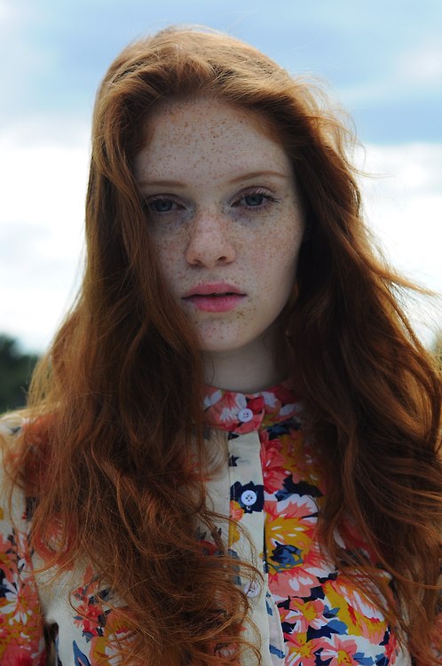 Freckles
