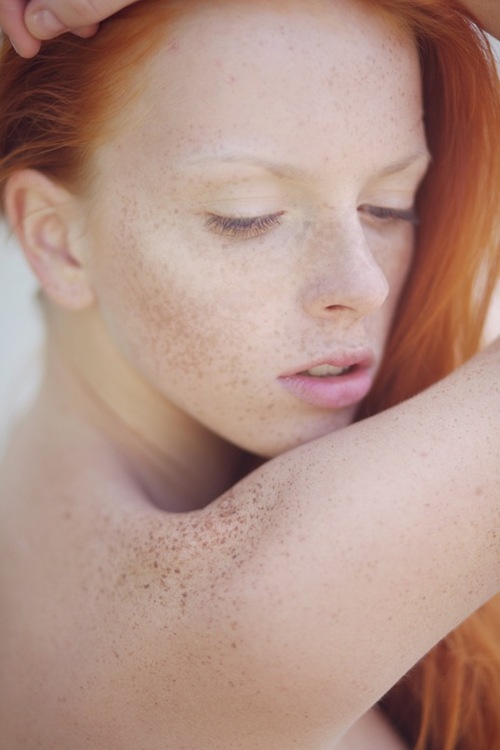 Freckles