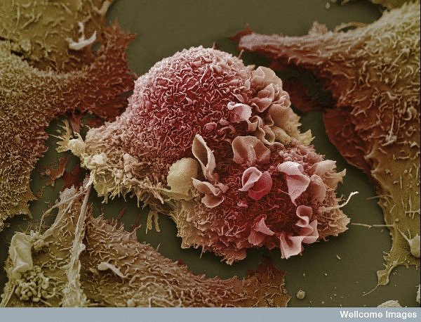 Lung Cancer Cell