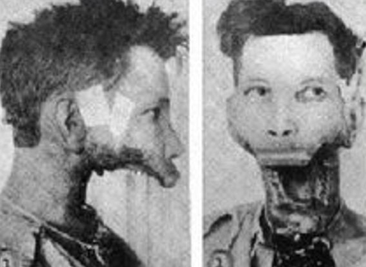 man who lost his jaw to radium