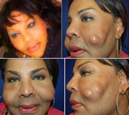 The woman who had concrete injected in her face by fake doctor.New pictures of an alleged victim of previously featured 'fake doctor' Oneal Ron Morris show the horrific damage to her face after it was injected with a toxic mixture of cement and tyre sealant. Rajee Narinesingh, 48, from Miami, Florida, says her face was ruined by Morris, who had just been released from custody after she was accused of administering the potentially lethal shots to another victim.