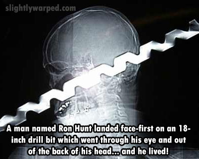 ron hunt - slightlywarped.com A man named Ron Hunt landed facefirst on an 18 inch drill bit which went through his eye and out of the back of his head... and he lived!