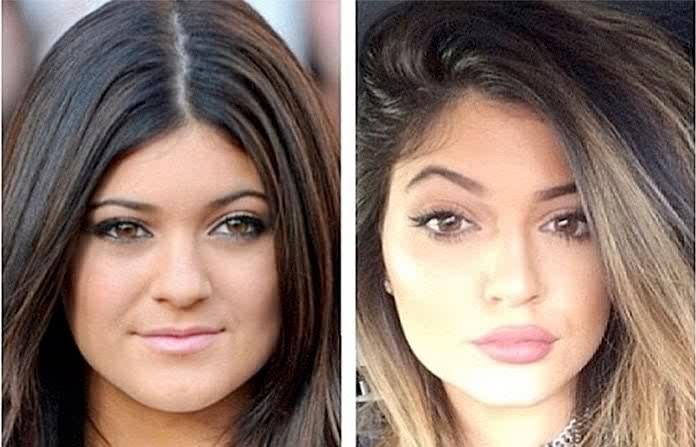 kylie jenner jaw surgery