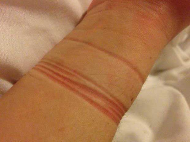 marks from a hair ties