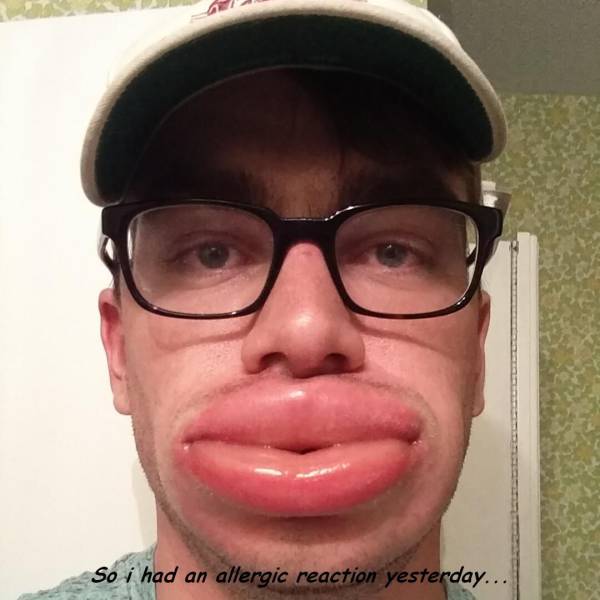 bee sting on lip - So i had an allergic reaction yesterday...