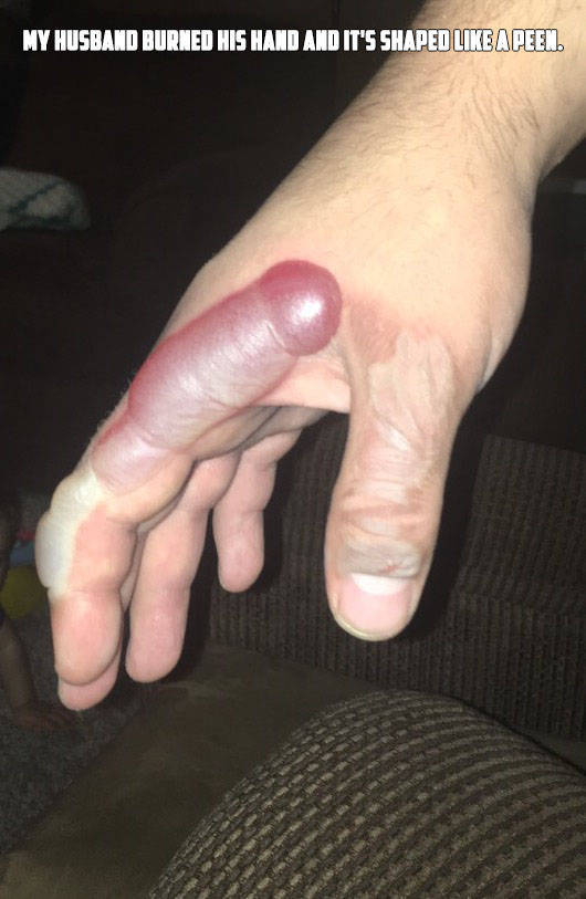 thumb - My Husband Burned His Hand And It'S Shaped A Peen.