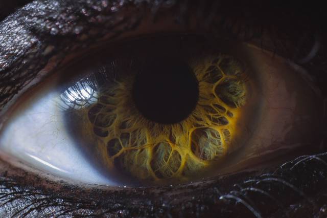 6 years ago I posted my wife's eye that her doctor told her was the weirdest he'd ever seen. Since then my photography's improved quite a bit, so here's a new pic I took a couple days ago.