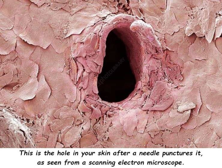 skin after needle penetrates - EphotoLIBRARY This is the hole in your skin after a needle punctures it, as seen from a scanning electron microscope.