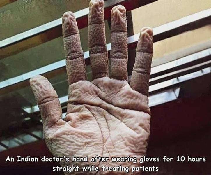 thumb - An Indian doctor's hand after wearing gloves for 10 hours straight while treating patients