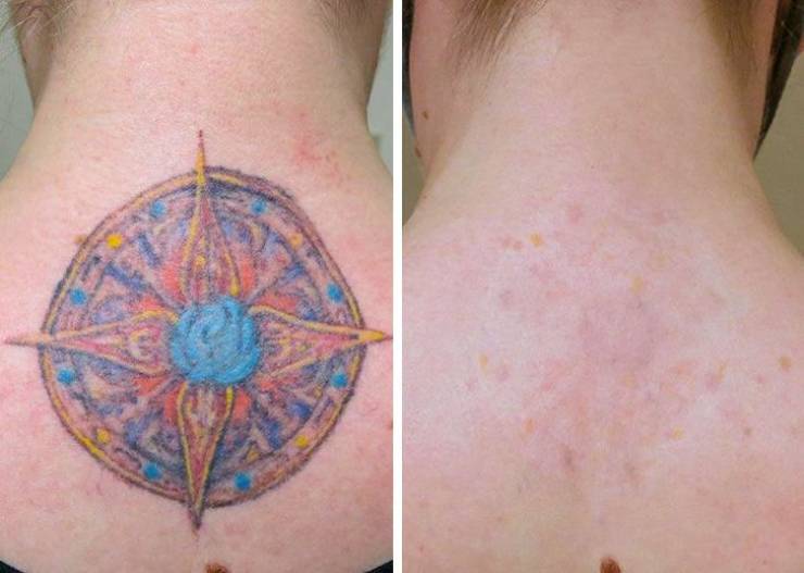 before and after tca tattoo removal