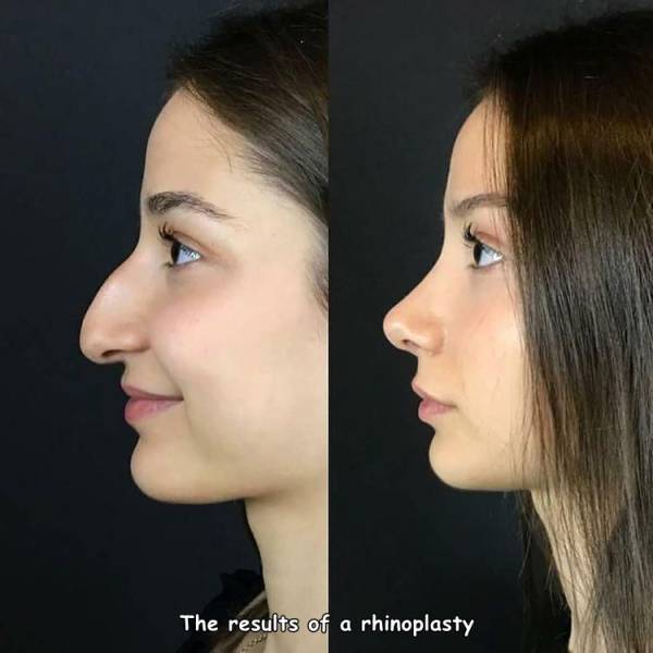 cool random pics - ultrasonic rhinoplasty before and after - The results of a rhinoplasty