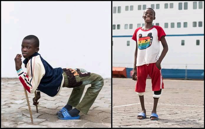 young boy named ulrich before and after surgery to fix his backwards legs