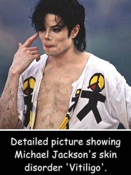 michael jackson vitiligo - K Detailed picture showing Michael Jackson's skin disorder 'Vitiligo'.