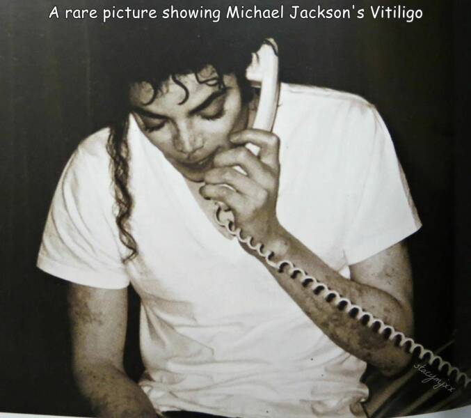 funny photos - michael jackson vitiligo - picture showing Michael Jackson's Vitiligo du my stacymjxx