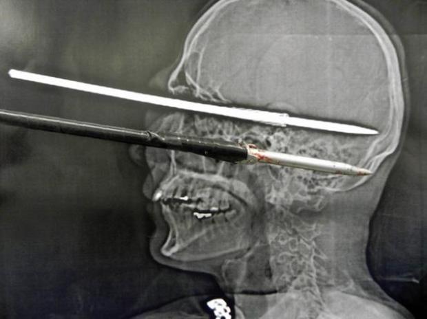 Fisherman hit with Speargun survives with minimal Brain Damage