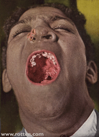 Syphilis Tertiaria -- Cicatrices palati mollis 