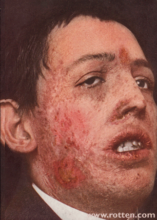 Lupus vulgaris 