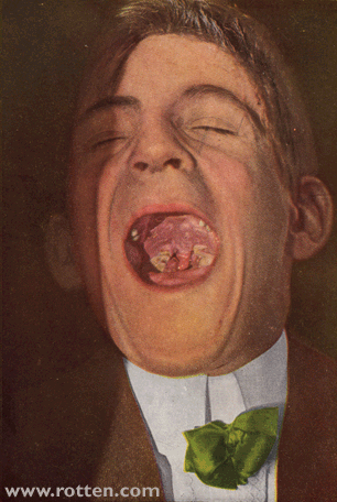 Syphilis Secundaria -- Syphilis papulosa mucosae oris 
