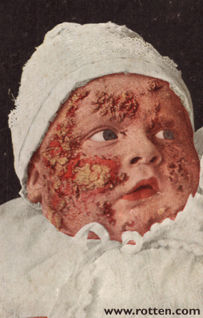 Eczema chronicum infantum 