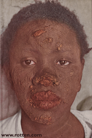 Lepra tubersosa 