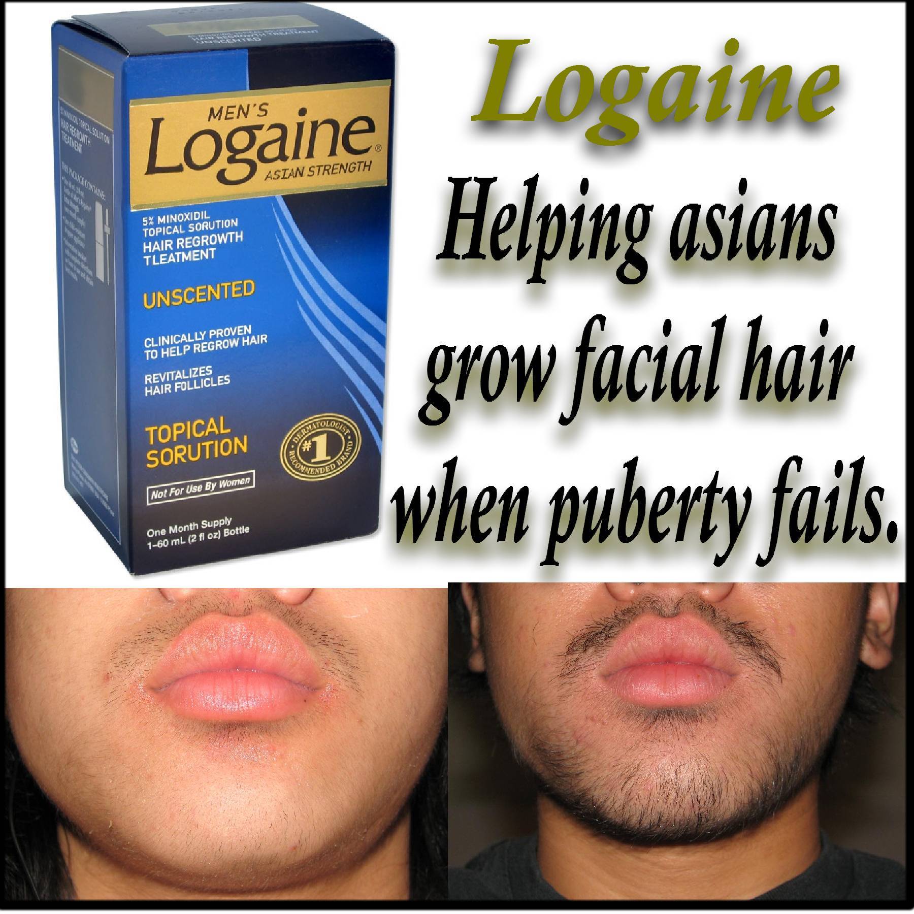 Logaine in Asian Strength, a topical sorution to glowing your facial hair when puberty fails.  Revitarizes hair forricles turning boys into boys with facial hair. 