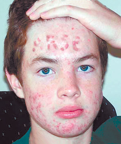 I bet this kid felt awkward at school with a word carved into his forehead with ACNE