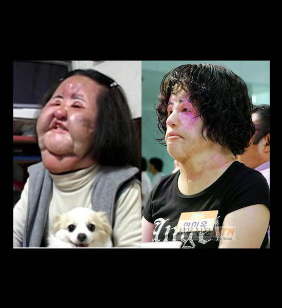 South Korean Hang Mioku Apparently Injected Cooking Oil In Her Face