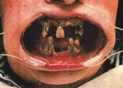 Gallery Of Horrible Teeth