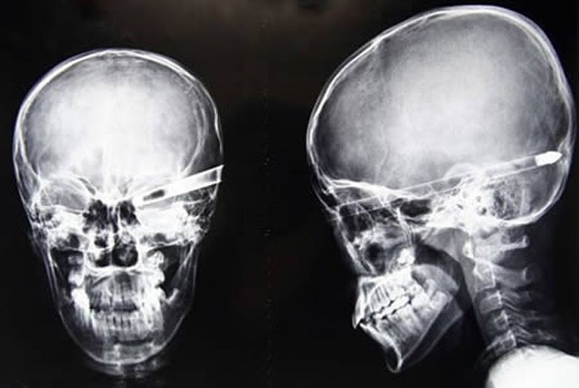 X-Rays Reveal Foreign Objects Inside People