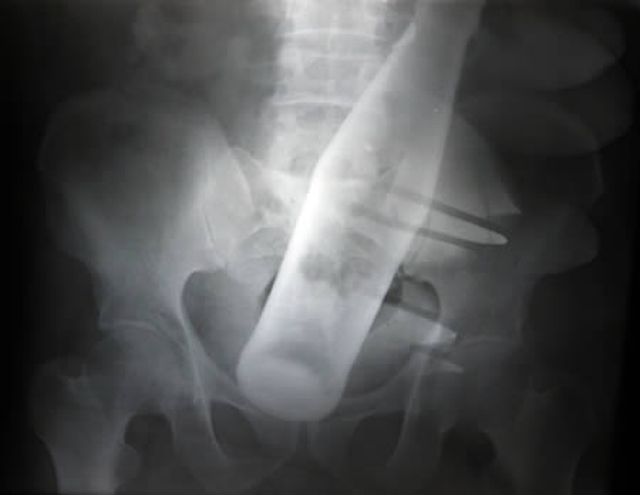 X-Rays Reveal Foreign Objects Inside People