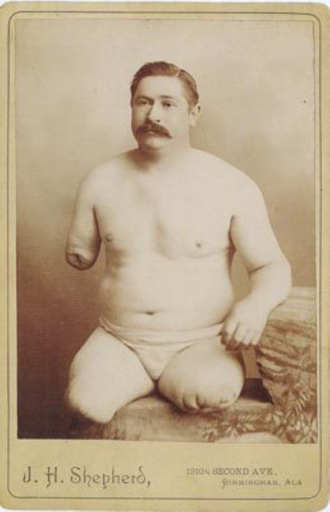 Triple Amputee - The thirty-two year old man pictured here had his legs and one arms crushed by a railroad car which was transporting building materials. He had to have all three limbs amputated. His was the second successful triple amputation in the United States.
