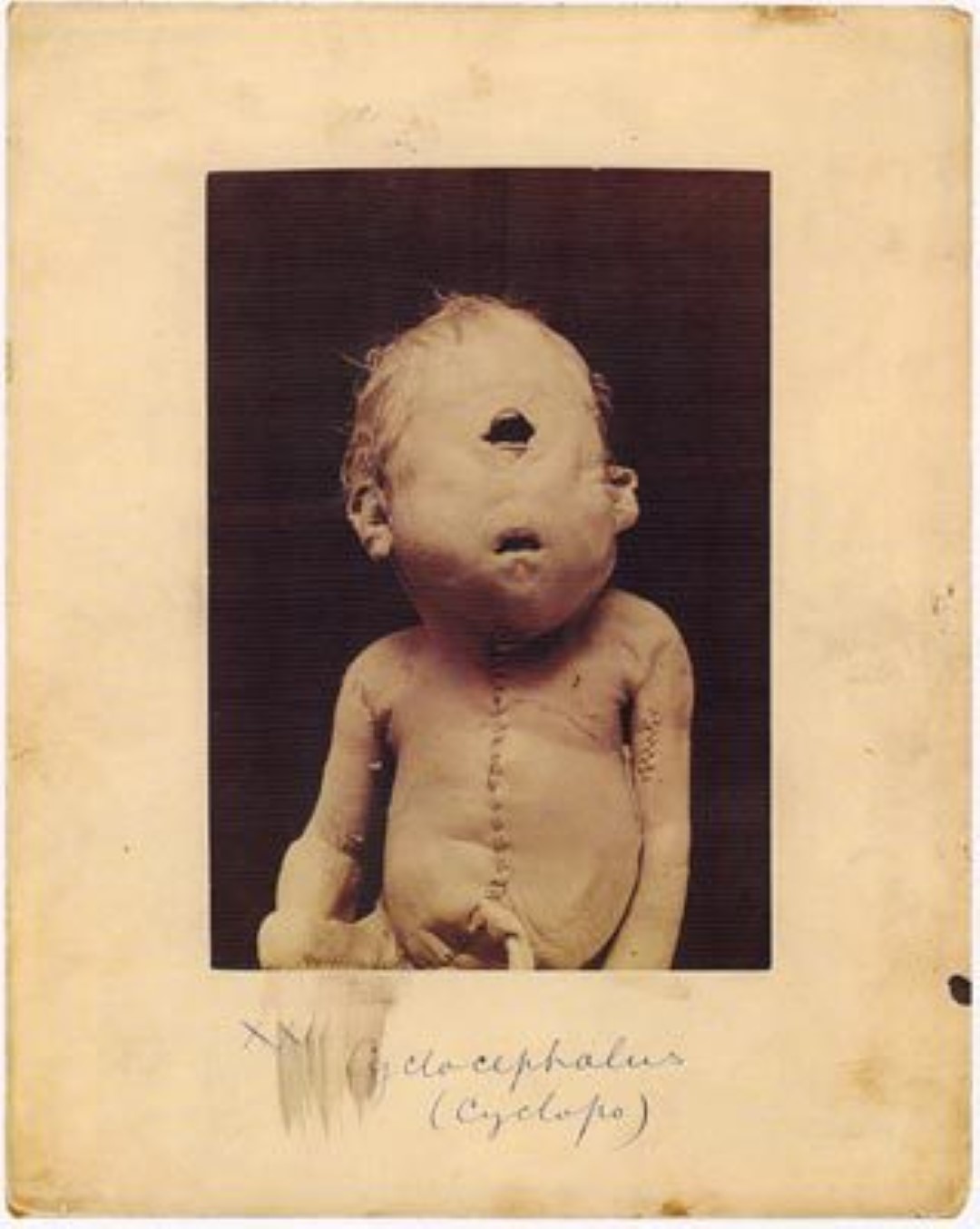 Cyclopia is a rare birth defect in which the body is unable to properly separate the two eye sockets so they remain merged as one. The majority of babies suffering this disease are stillborn but if they survive it is not usually for more than a few hours.