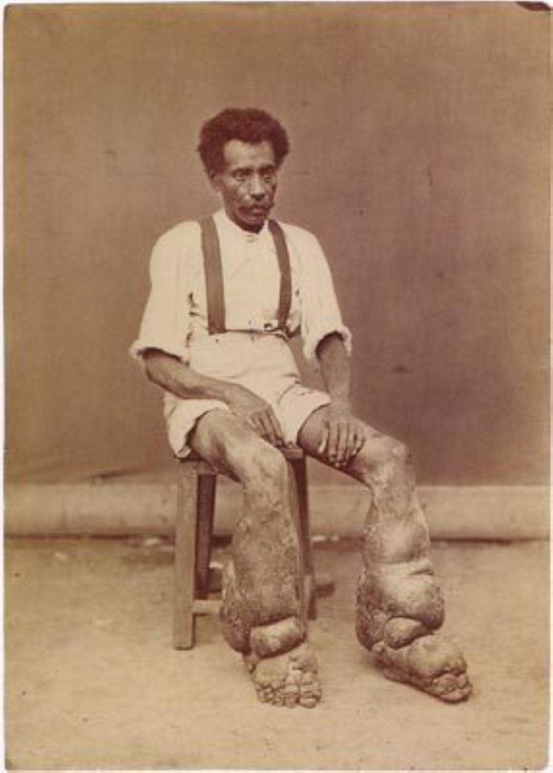 Elephantiasis - He was so distressed by his condition that he begged for amputation. Instead an experimental surgery was performed on him which successfully removed much of the excess tissue. Unfortunately, however, he died five months later.