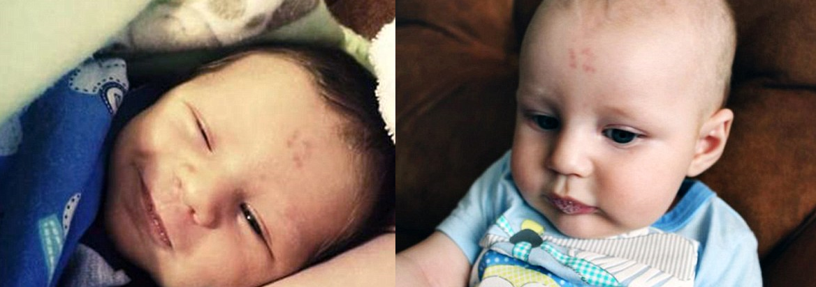 Baby Born With A Birthmark That Looks Like The Number '12'