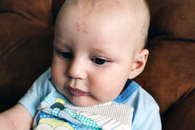 A birthmark is an irregularity that appears on the skin that can appear before or shortly after birth. Depending on the type of birthmark, they are caused when blood vessels either don’t form properly or crowd around a specific area on the skin, leaving a distinct mark. Birthmarks do not hurt and usually fade or disappear completely with time.